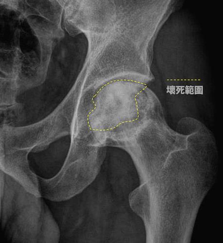 不當飲酒影響骨骼健康　朴子醫院賴彥州醫師提醒年終尾牙聚餐要小心